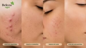 Tipos de acne. Entenda os tipos de acne, seus graus e como tratar cada um com uma abordagem natural, vegana e eficaz.