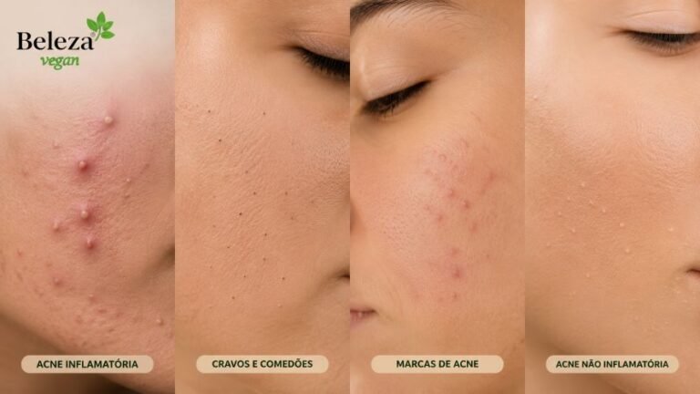 Tipos de acne. Entenda os tipos de acne, seus graus e como tratar cada um com uma abordagem natural, vegana e eficaz.